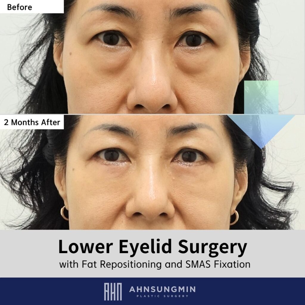Lower Eyelid Fat Repositioning 2 Month Result: Natural Contour Without Hollowing