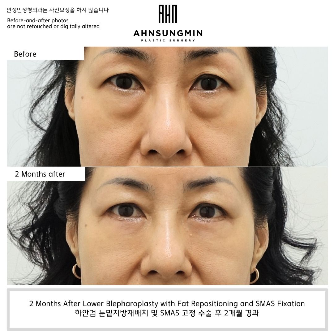 lower eyelid fat repositioning before and after 2 months natural contour improvement without hollowing