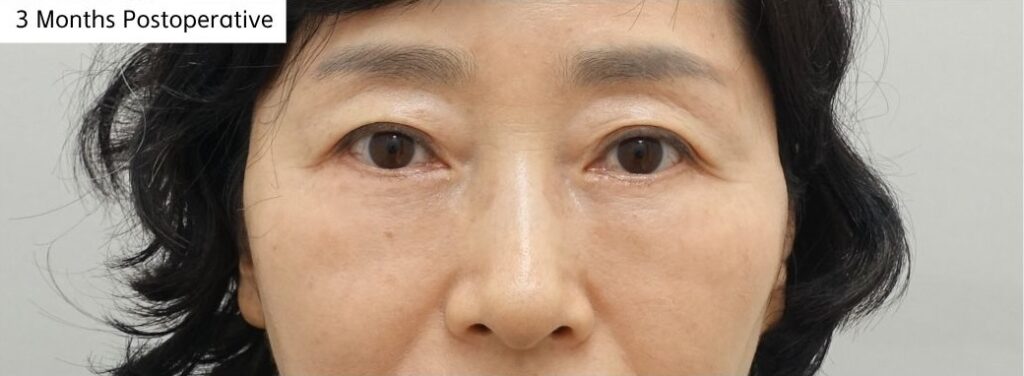 lower eyelid 3 months after surgery natural contour improvement after fat repositioning without hollowing
