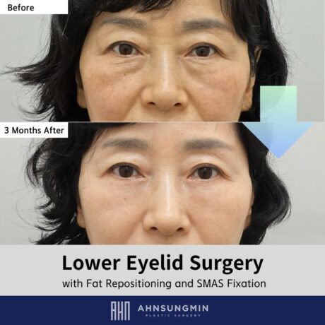 Lower Eyelid Surgery Recovery Timeline: When Results Become Natural