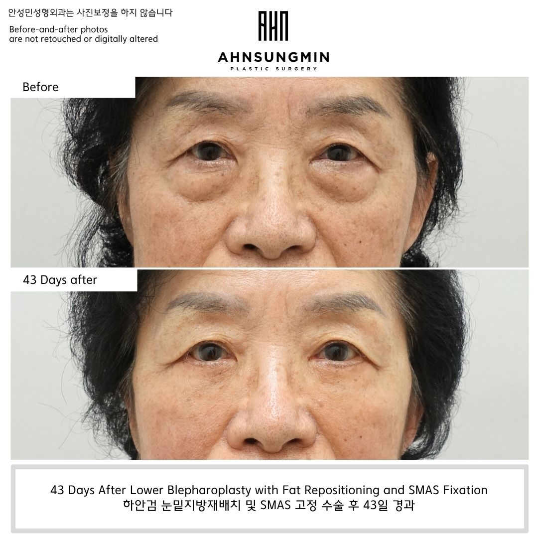 lower eyelid fat repositioning before and after 43 days natural contour improvement without hollowing