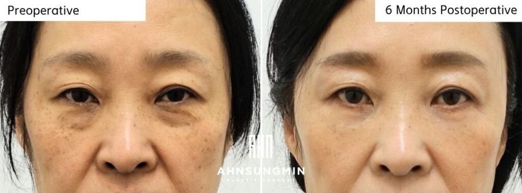 Preoperative and 6 months postoperative results after lower eyelid fat repositioning surgery in Korea showing improvement of under-eye hollowing and lower eyelid contour