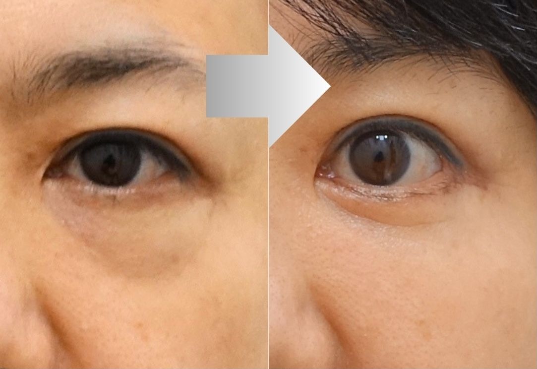 Lower eyelid fat repositioning with natural aegyo-sal preservation before and after in Korea