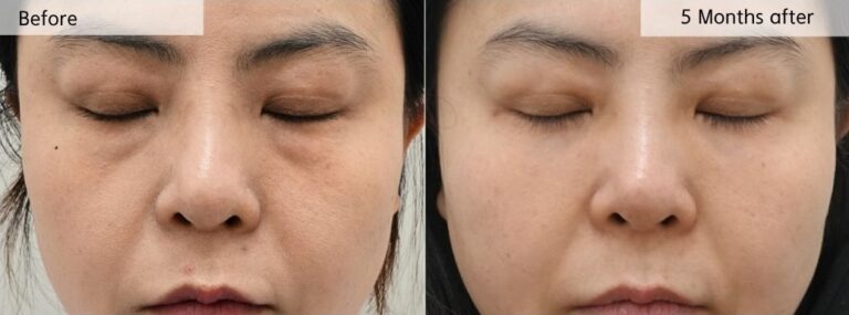 Before and 5 months after lower eyelid fat repositioning surgery showing smoother under-eye contour with preserved natural volume.