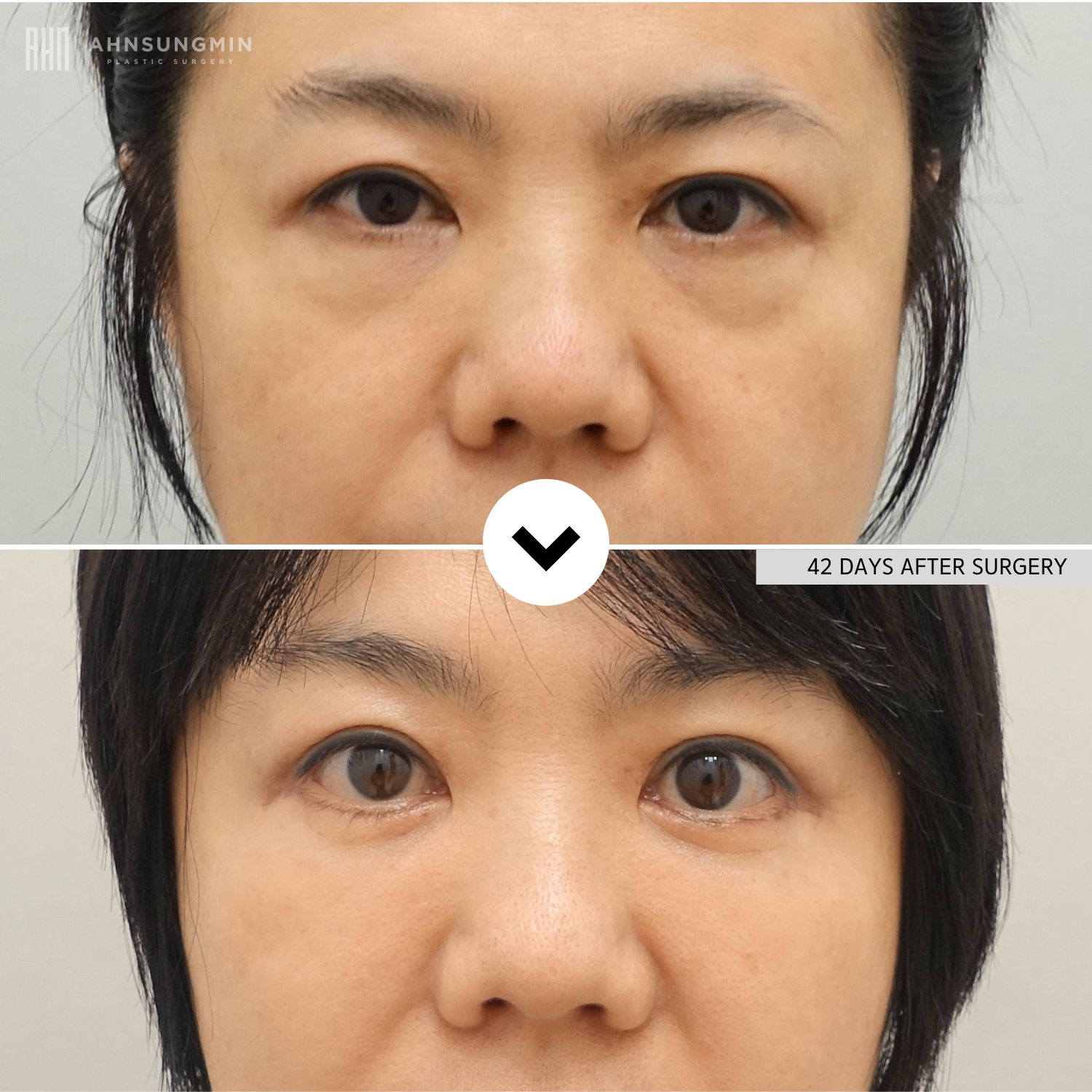 Before and 42 days after lower eyelid fat repositioning surgery in Korea showing reduced under-eye bags and smoother lower eyelid contours.