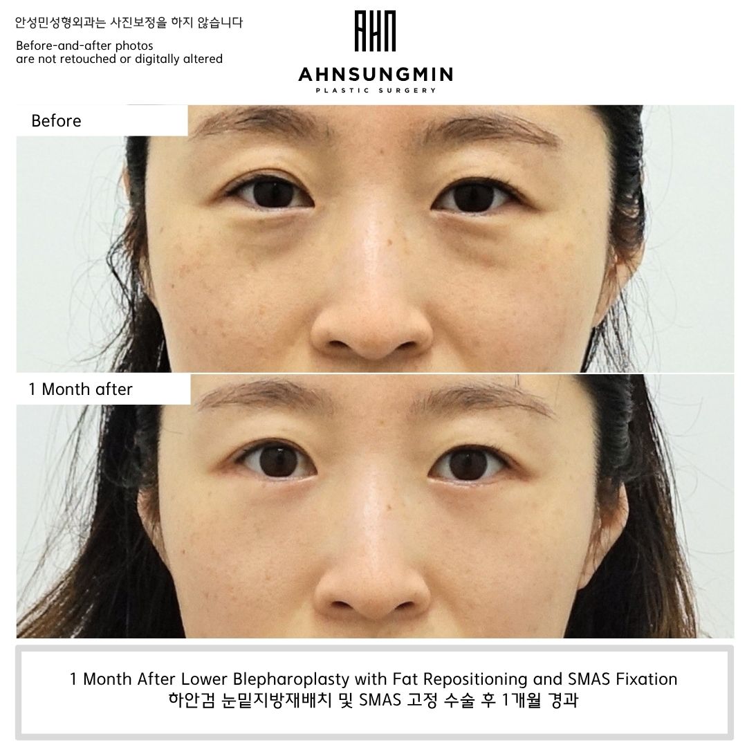 lower eyelid fat repositioning before and after 1 month dark circle improvement from structural shadow