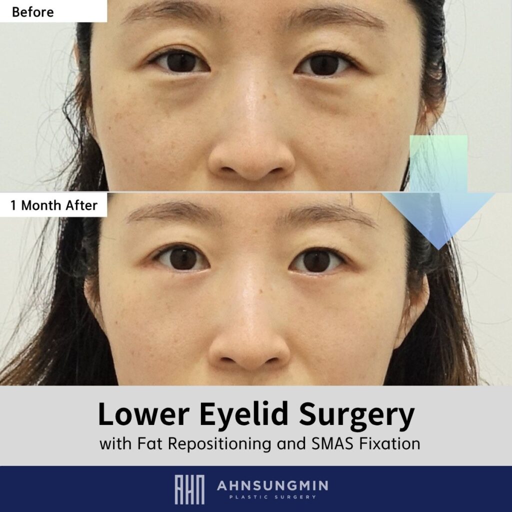 Dark Circles Improved with Lower Eyelid Fat Repositioning: 1 Month Result