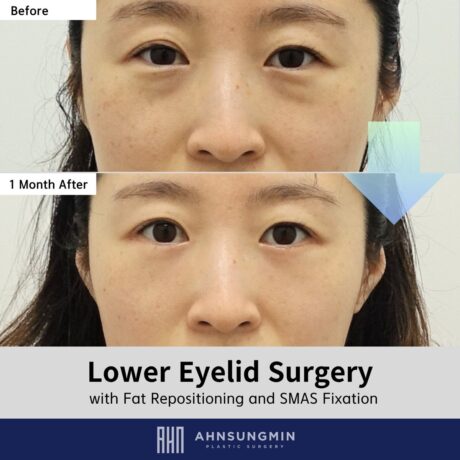 Dark Circles Improved with Lower Eyelid Fat Repositioning: 1 Month Result