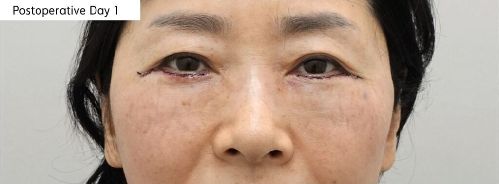 lower eyelid postoperative day 1 swelling and bruising after fat repositioning dressing visit