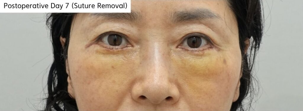 lower eyelid postoperative day 7 suture removal reduced swelling after fat repositioning surgery