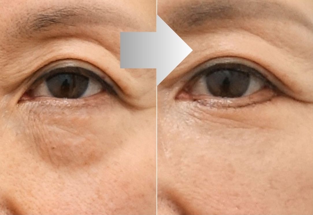 Lower eyelid fat repositioning for hollow under eyes before and after in Korea