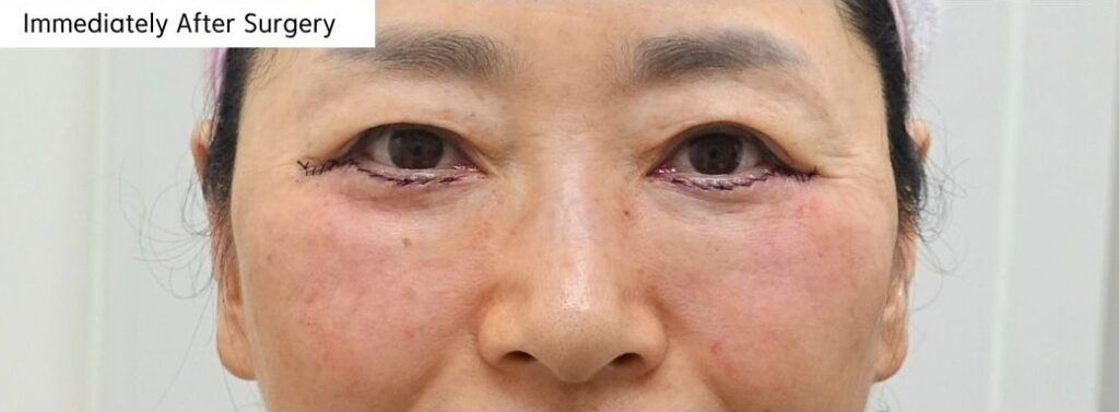 lower eyelid immediately after surgery swelling and sutures visible after fat repositioning