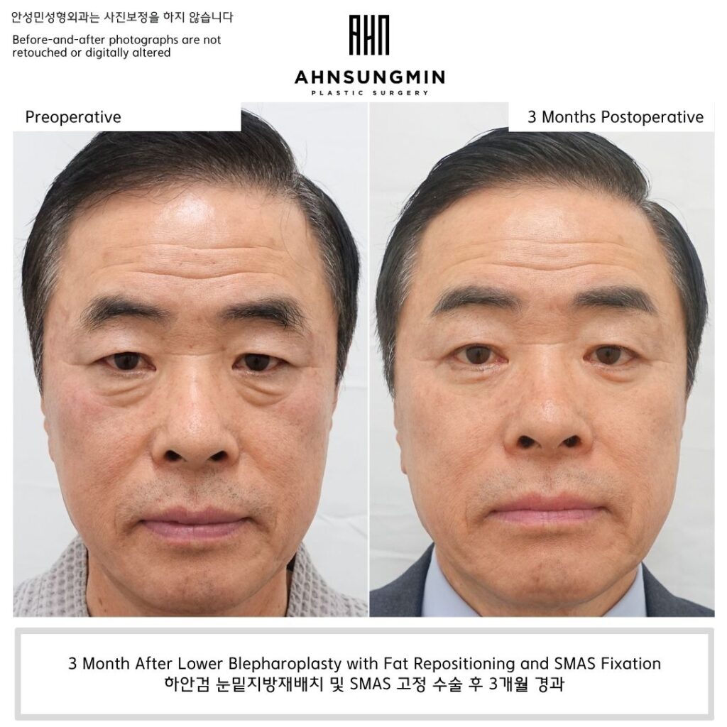 lower eyelid fat repositioning male 50s before and after 3 months natural result preserving under eye contour