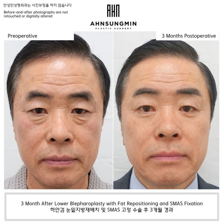 lower eyelid fat repositioning male 50s before and after 3 months natural result preserving under eye contour