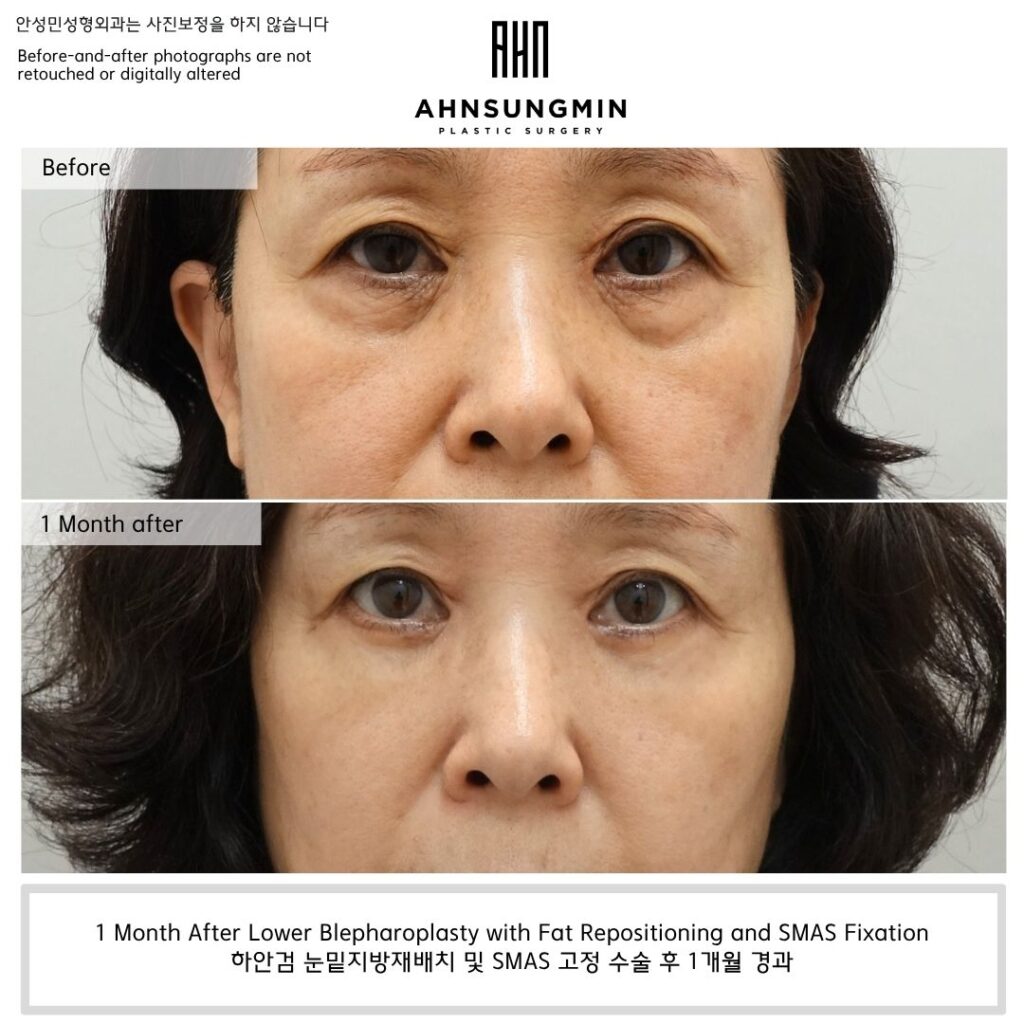 lower eyelid fat repositioning before and after 1 month natural result without hollowing