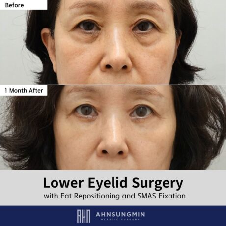 Why We Did Not Remove Fat in This Lower Eyelid Case.