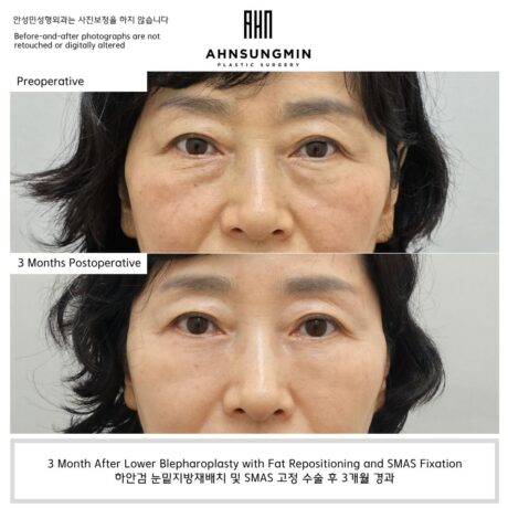 Why Excessive Skin Removal Is the Beginning of Failure in Lower Eyelid Surgery.