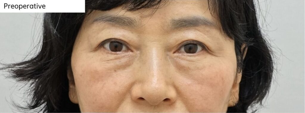 lower eyelid preoperative under eye bulging and shadowing before fat repositioning surgery