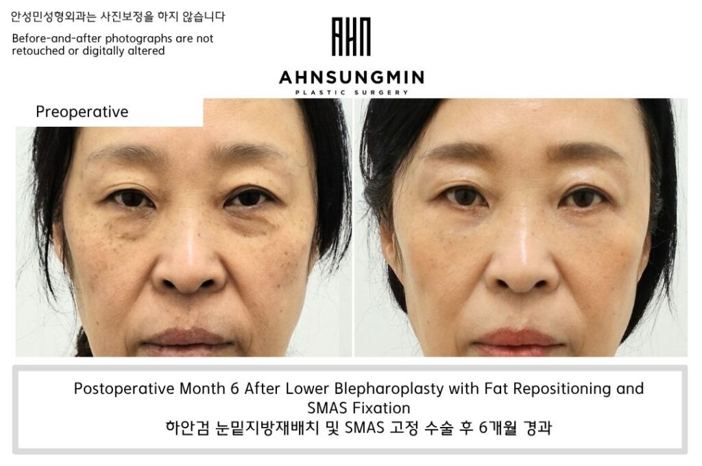 lower eyelid fat repositioning with smas fixation result showing natural contour without hollow under-eye
