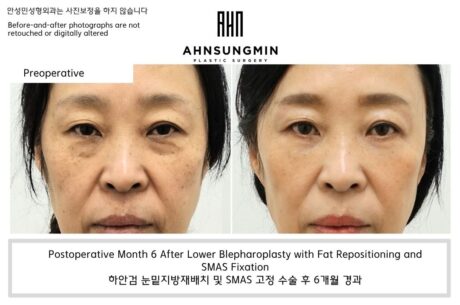 Hollow Under-Eye After Surgery? Why It Happens and How to Prevent It