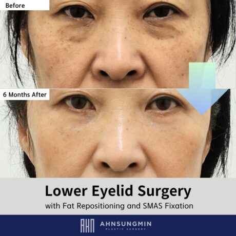 Why Lower Eyelid Hollowing Happens Over Time.