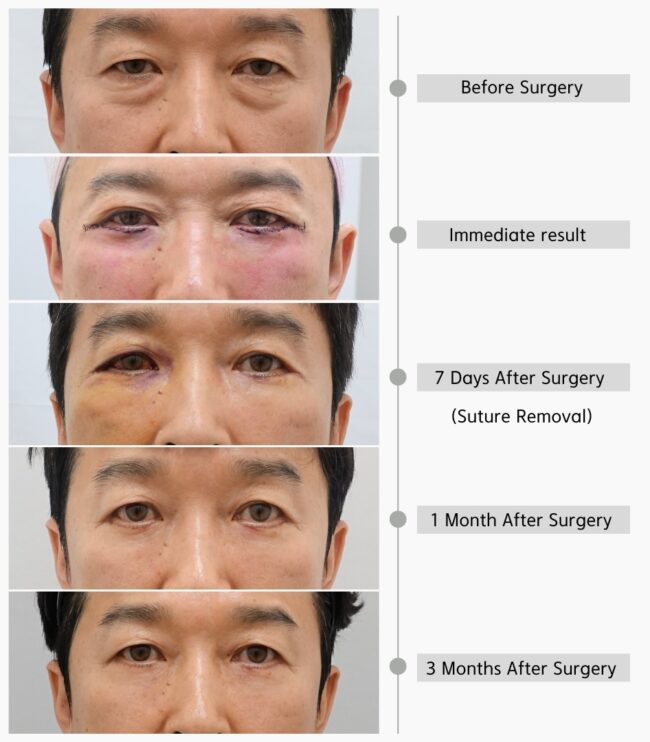 Lower Blepharoplasty In Korea Natural Looking Lower Eyelid Surgery lower-blepharoplasty-in-korea-natural-looking-lower-eyelid-surgery
