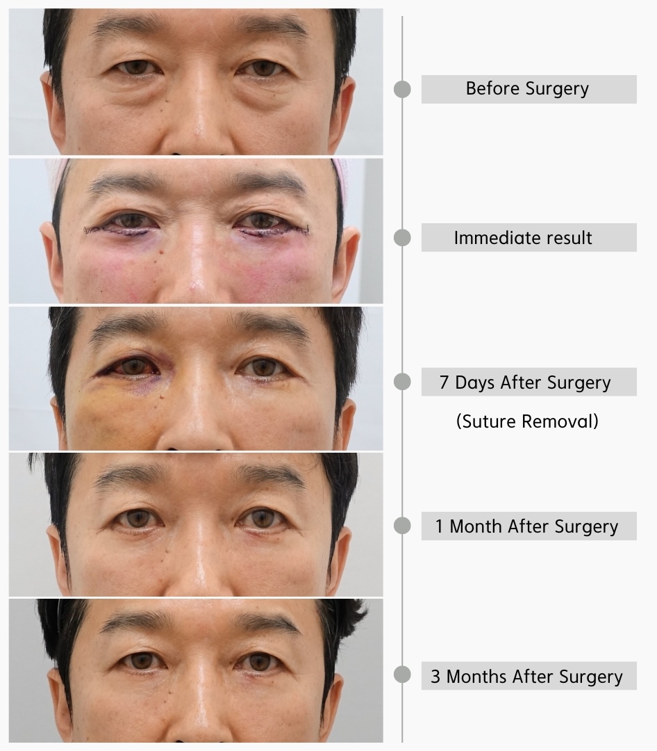 Lower eyelid surgery recovery timeline showing before surgery, immediate postoperative appearance, 7 days after surgery, 1 month after surgery, and 3 months after surgery