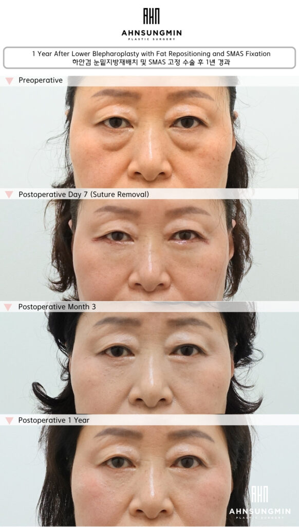 Why This Lower Eyelid Result Remained Stable After One Year.