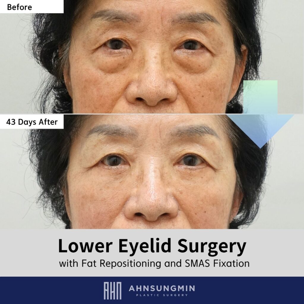 Lower Eyelid Fat Repositioning at 43 Days: Early Volume Restoration in a Patient in Her 60s