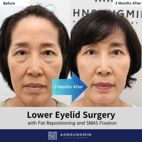 Recovery Timeline After Lower Eyelid Surgery: 3 Months After Fat Repositioning and SMAS Fixation.