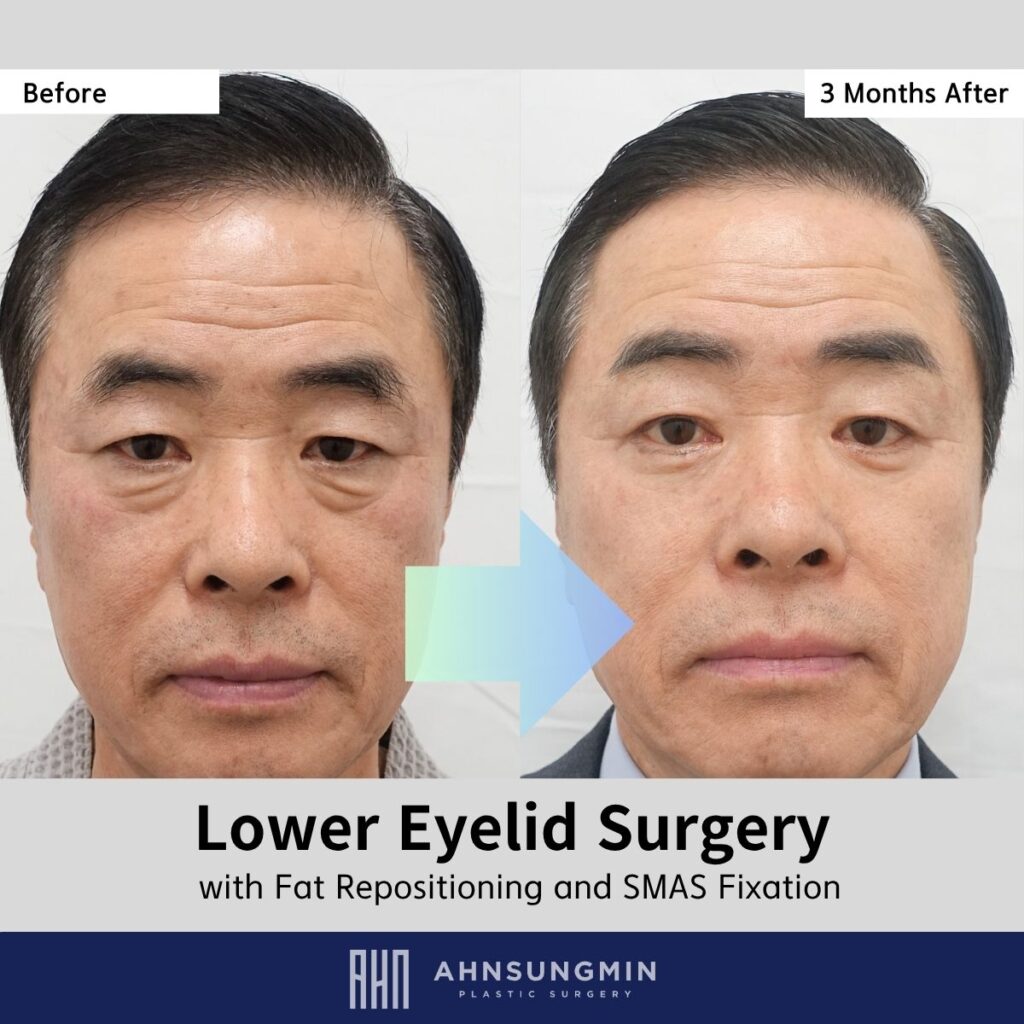 Overcorrection Can Ruin Results: Natural Lower Eyelid Surgery in a Male Patient (3 Months)