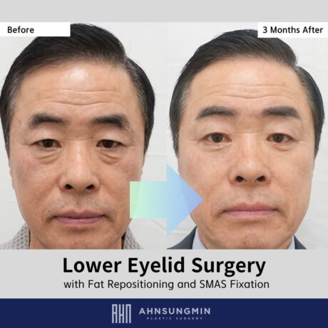Overcorrection Can Ruin Results: Natural Lower Eyelid Surgery in a Male Patient (3 Months)