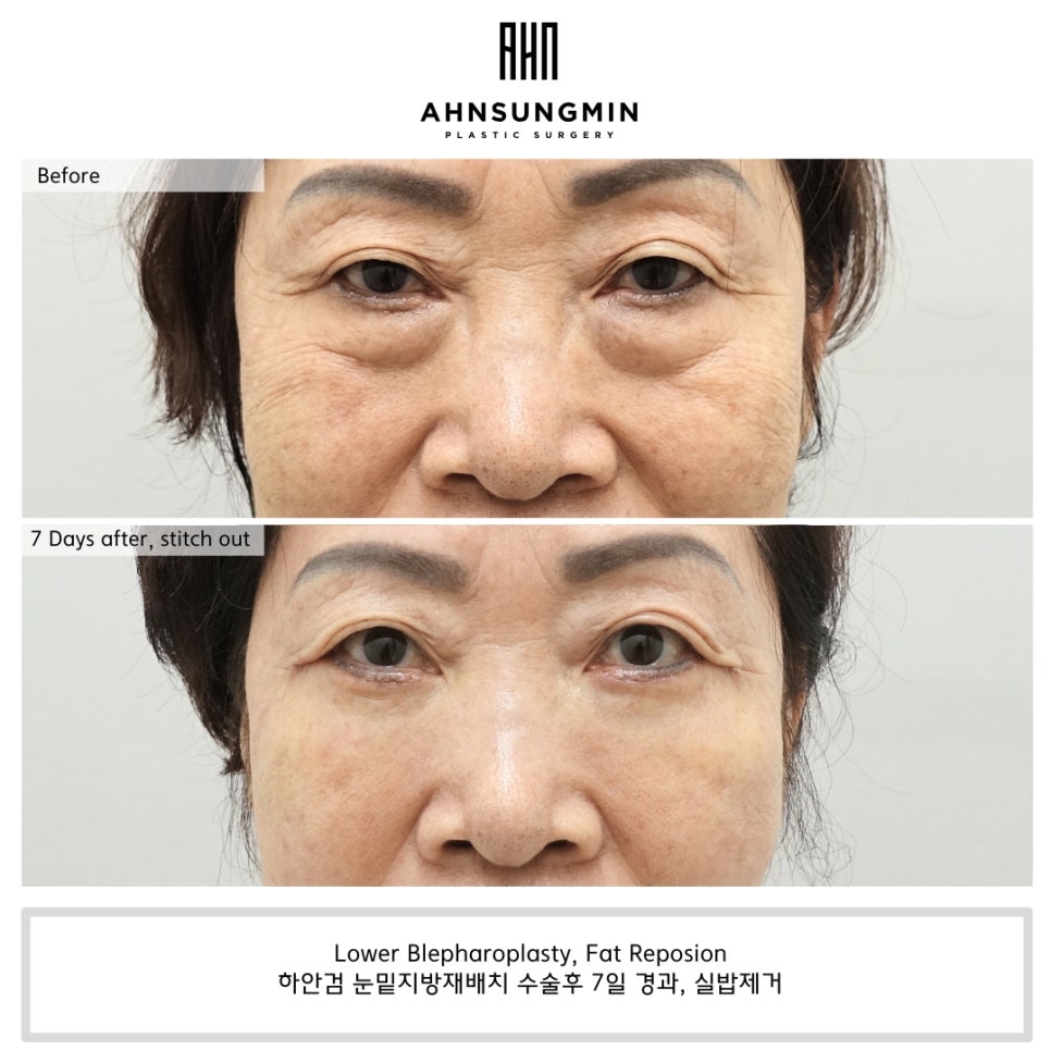 close-up recovery image 7 days after lower eyelid surgery and fat repositioning in Korea