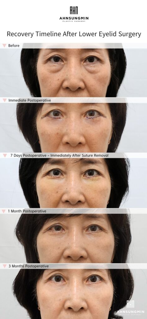 Lower eyelid surgery recovery timeline showing before surgery, immediate postoperative results, 7 days, 1 month, and 3 months after lower blepharoplasty in Korea