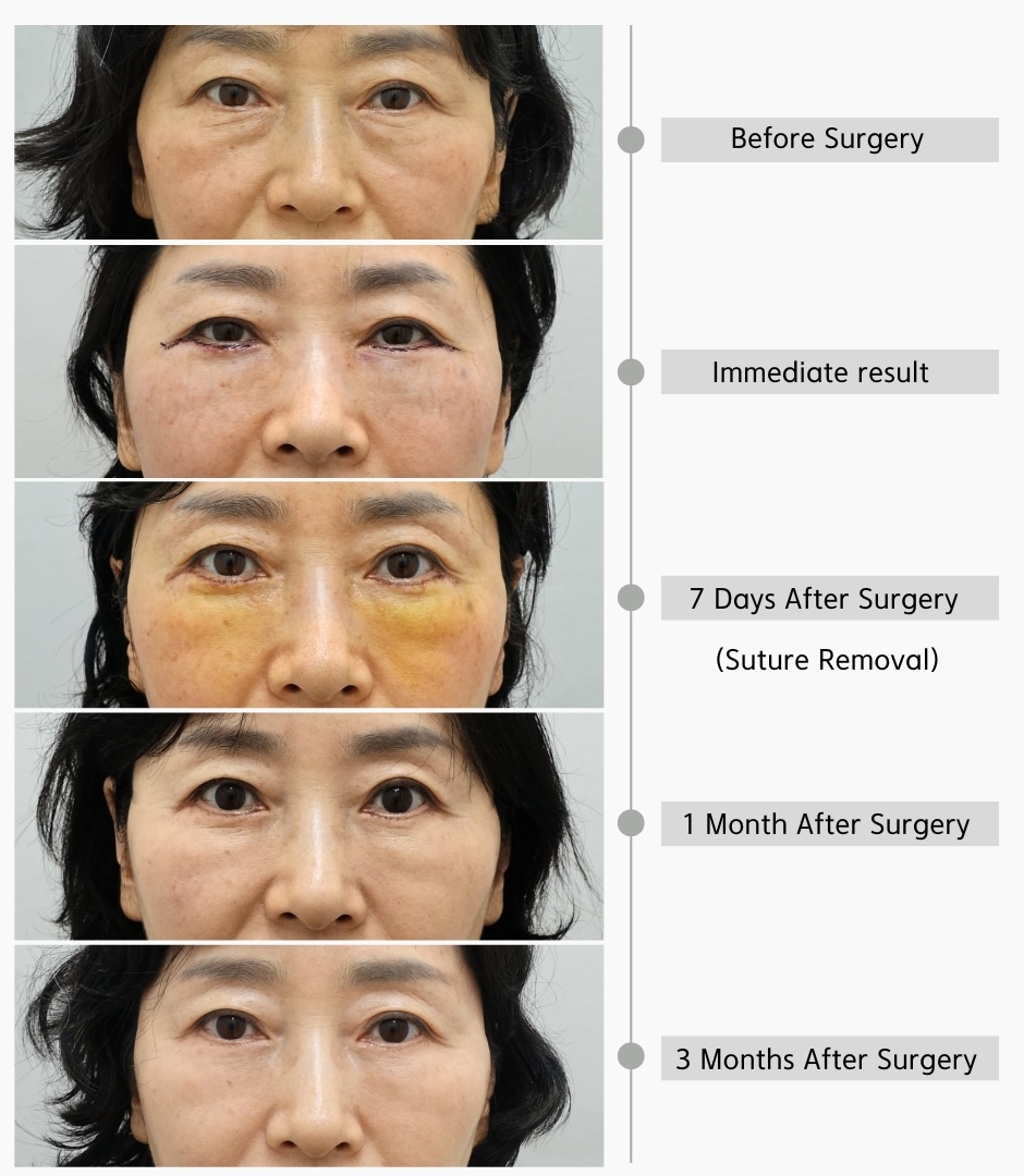 Lower eyelid surgery recovery timeline showing before surgery, immediate postoperative appearance, 7 days after surgery, 1 month after surgery, and 3 months after surgery in a woman in her 50s
