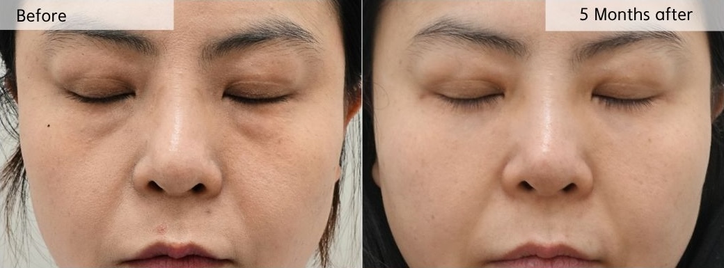 lower eyelid volume comparison eyes closed before and after 5 months fat repositioning result