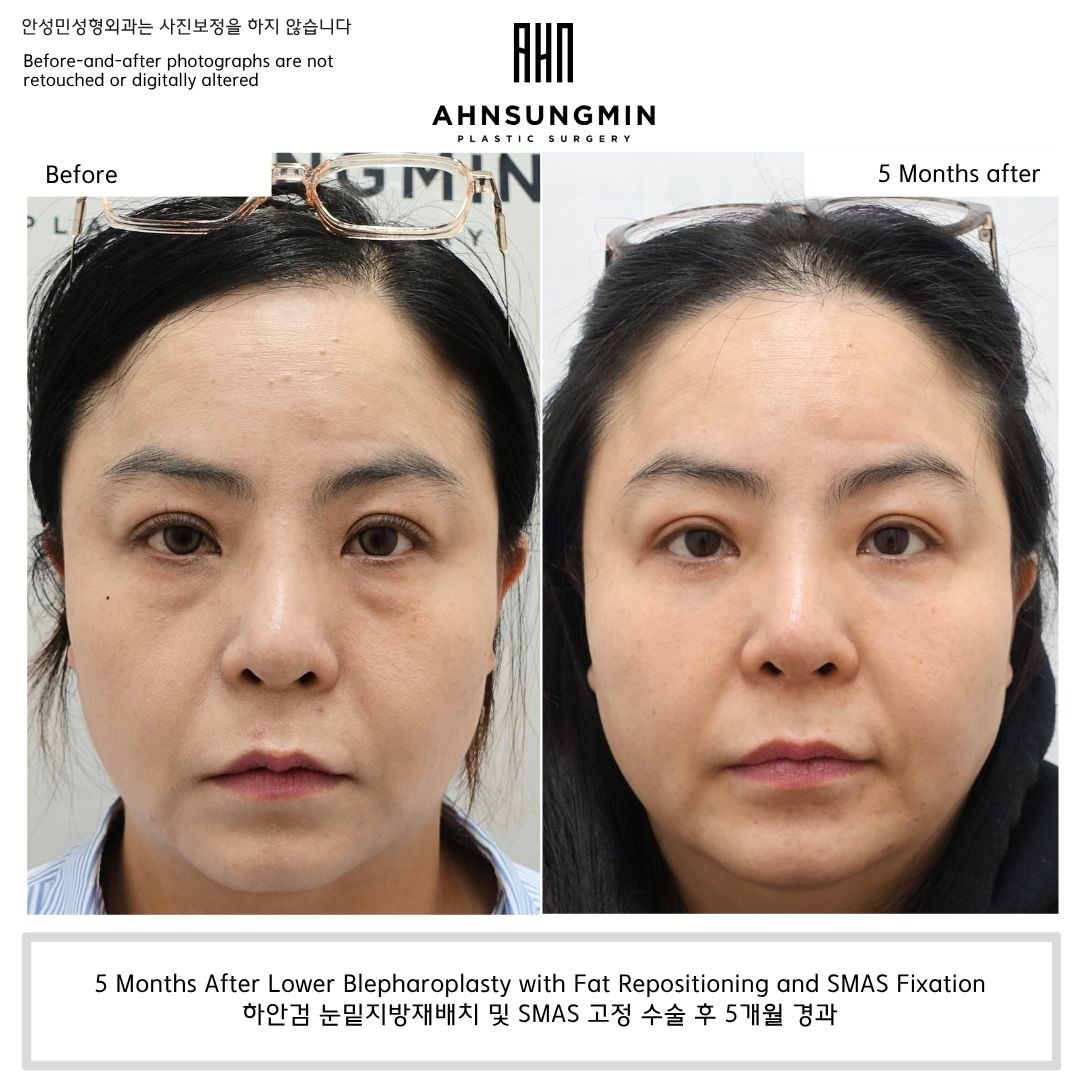 lower eyelid volume improvement before and after 5 months fat repositioning smas fixation natural result