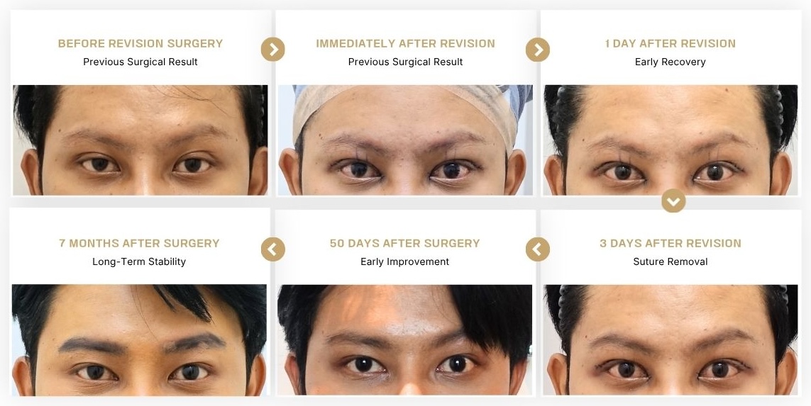 Male eyelid revision recovery timeline showing high crease lowering and ptosis correction from before revision surgery to 7 months after surgery at AHNSUNGMIN Plastic Surgery in Korea.