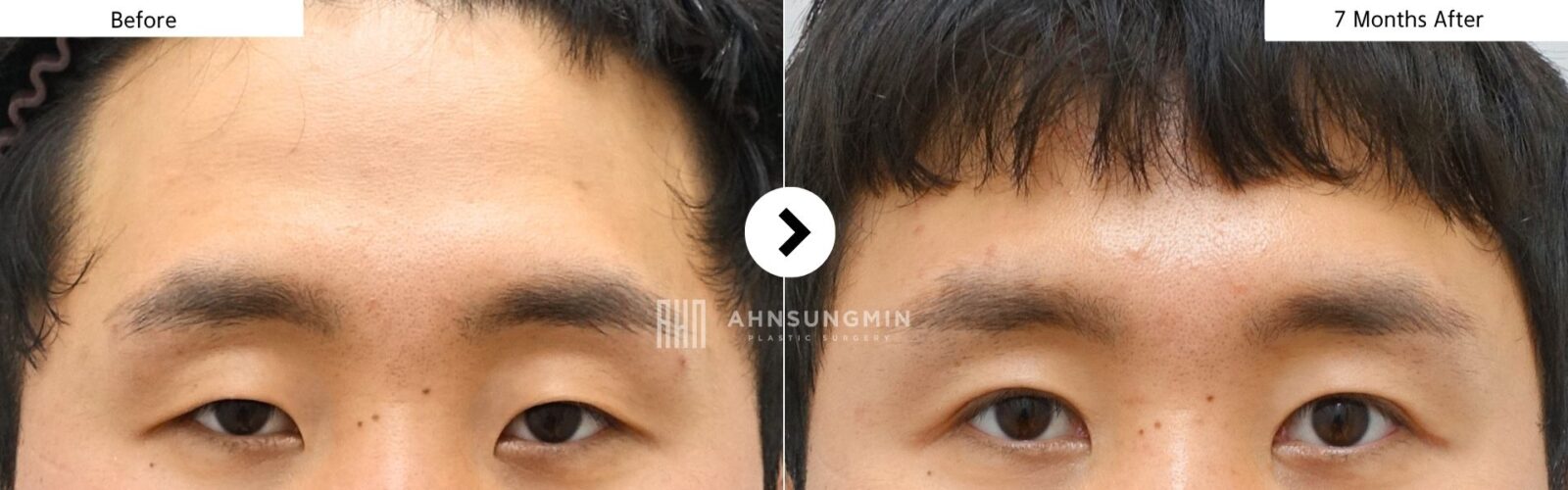 Male eyelid surgery in Korea before and 7 months after, showing a more open eyelid appearance with a natural, subtle masculine eyelid contour.