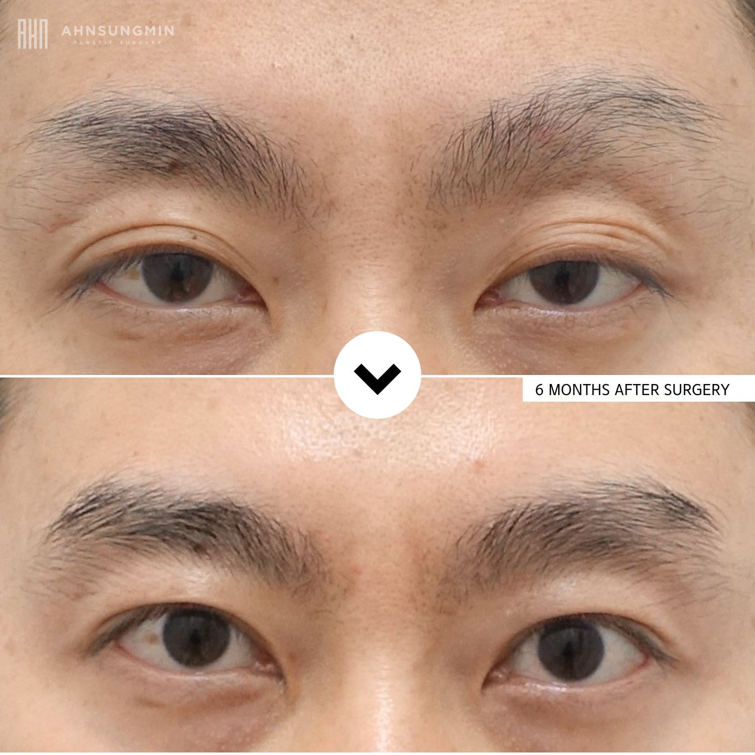 Before and after male eyelid surgery in Korea showing natural upper eyelid improvement and brighter eye opening.