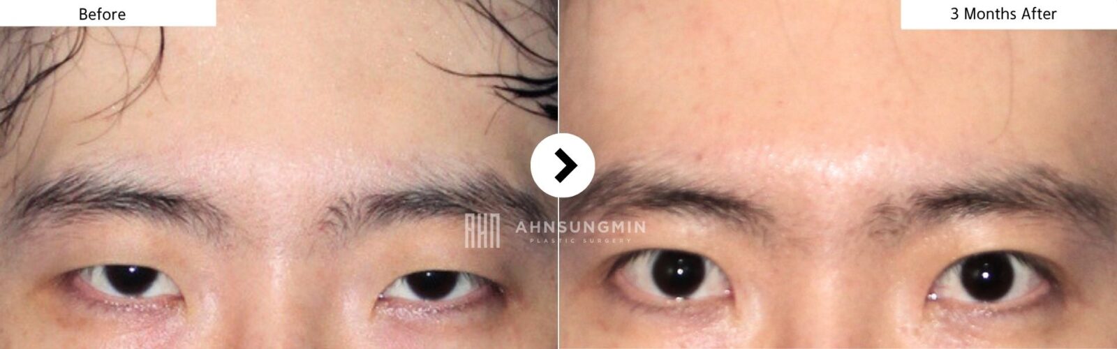 Male eyelid surgery in Korea before and 3 months after, showing improved eyelid opening while maintaining a natural masculine appearance.