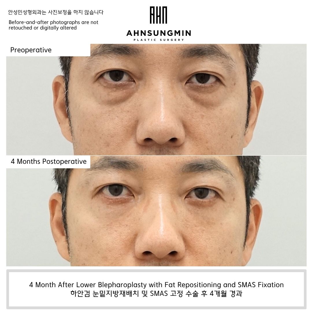 Male patient 4 months after lower blepharoplasty surgery in Korea