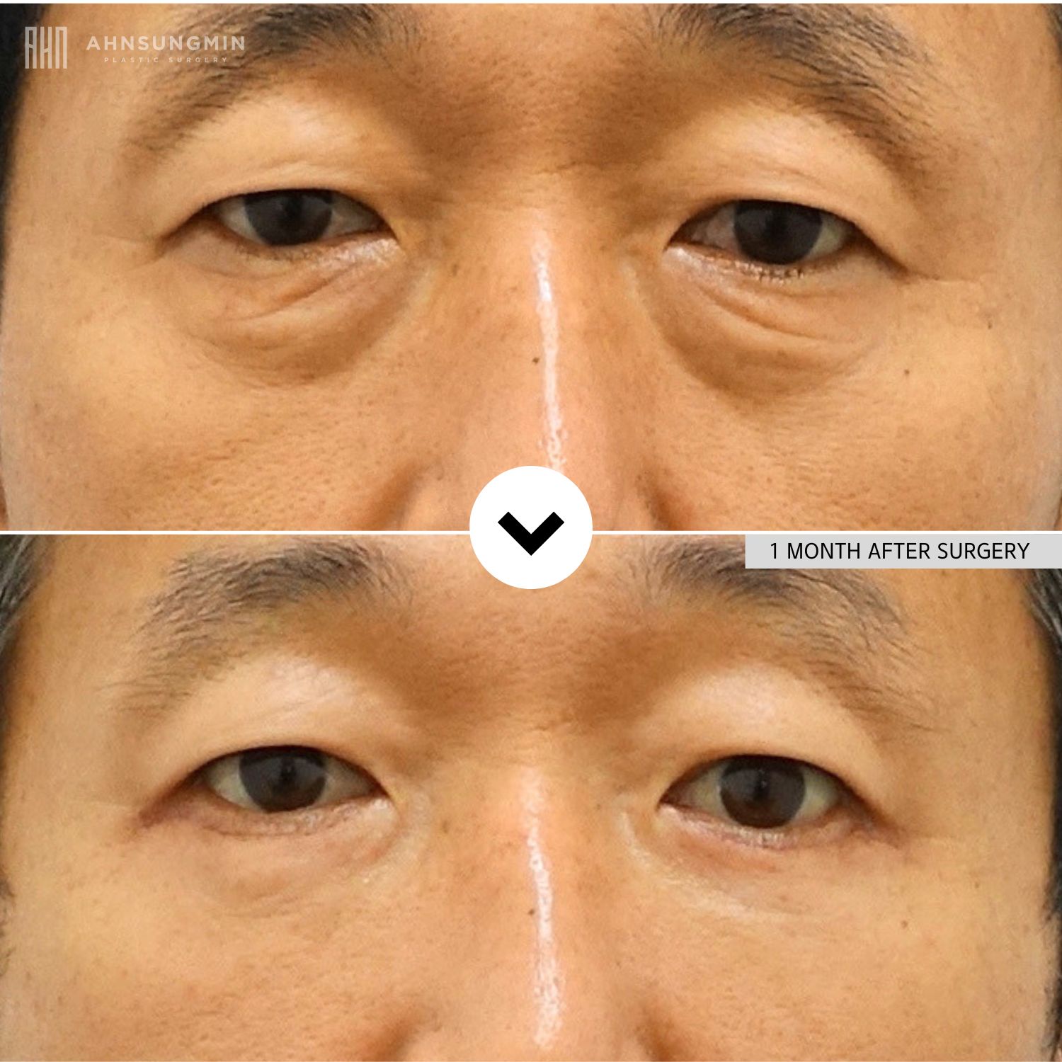 Before and 1 month after lower blepharoplasty in a male patient showing reduced under-eye bags and smoother lower eyelid contours.