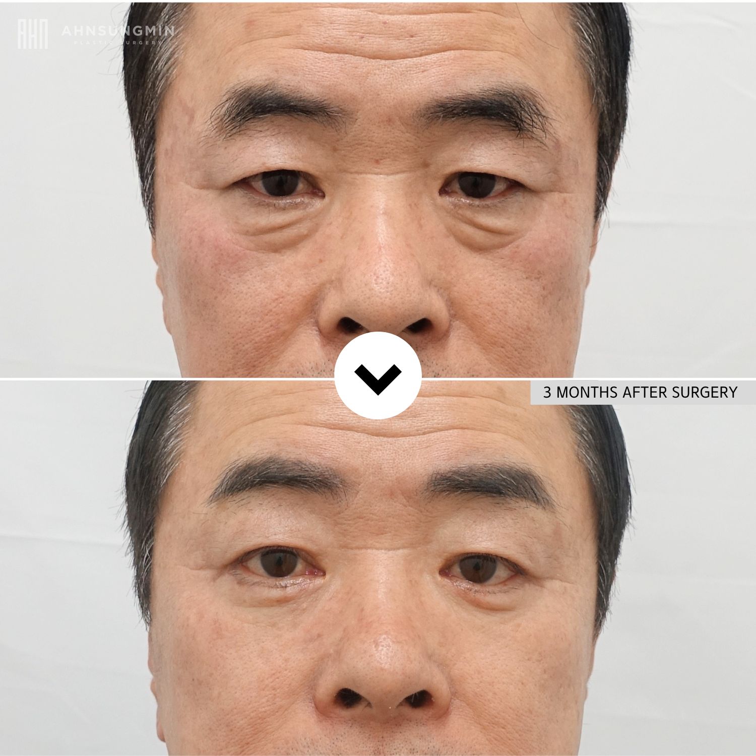 Before and 3 months after lower blepharoplasty in a male patient showing smoother lower eyelid contours and reduced under-eye bags.