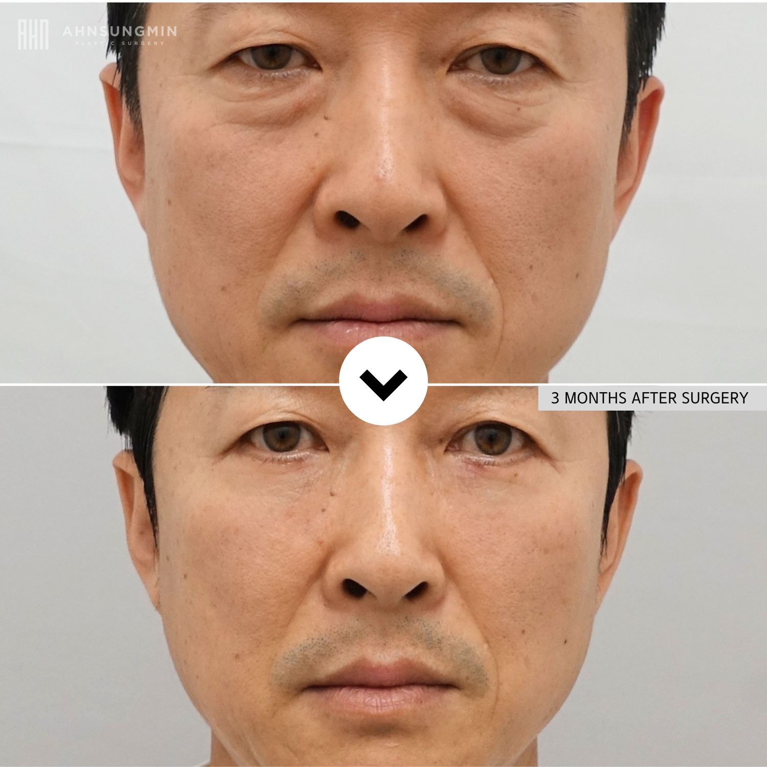 Before and 3 months after male lower blepharoplasty in Korea showing reduced under-eye bags and a refreshed masculine appearance.
