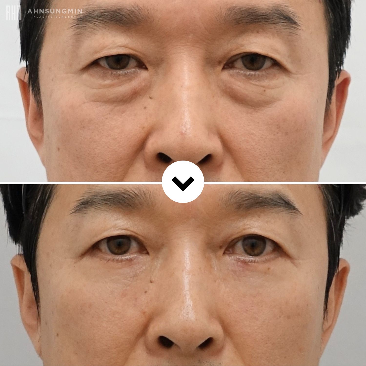 Before and after male lower blepharoplasty in Korea showing reduced under-eye bags and a refreshed natural appearance