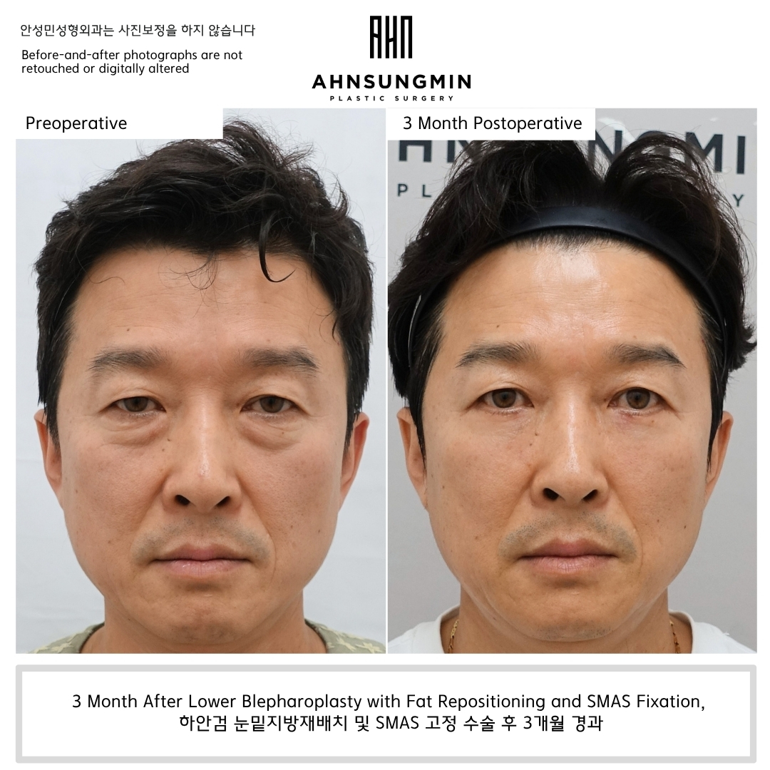 Male patient 3 months after lower blepharoplasty with fat repositioning and SMAS fixation in Korea showing smoother under-eye contours and a more rested appearance