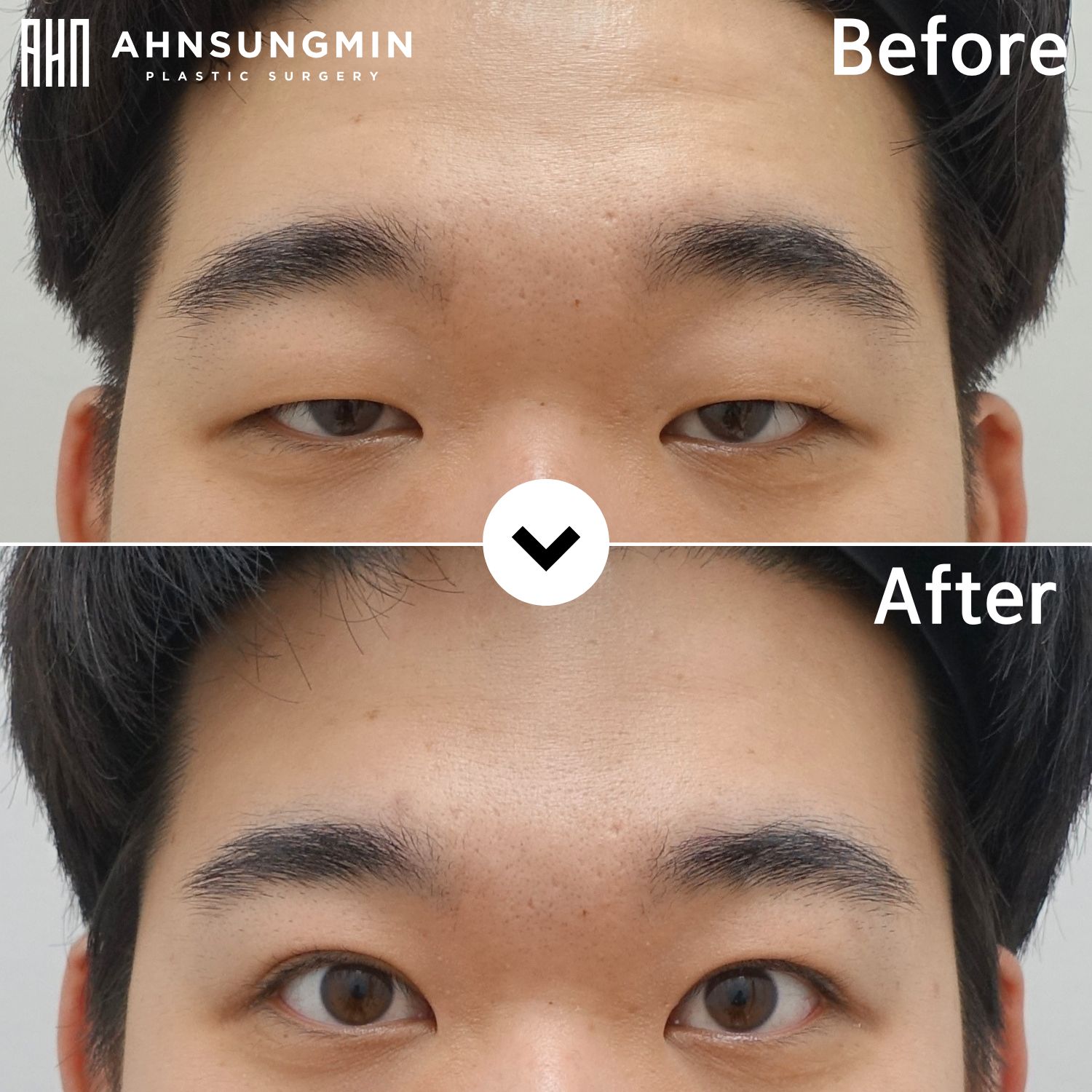 Male ptosis correction in Korea before and after 4 months showing stable and natural eyelid opening