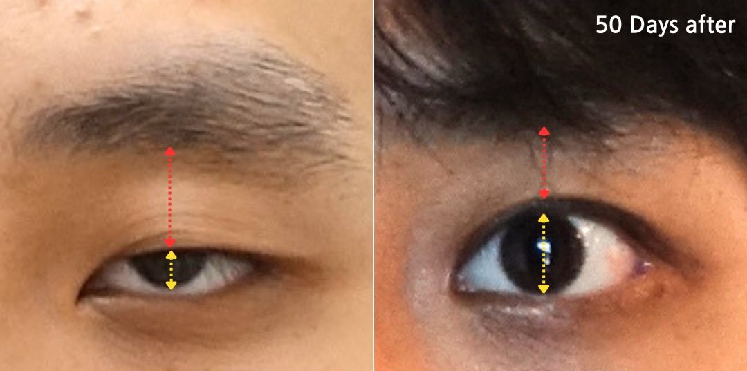 Male ptosis correction in Korea before and after 50 days showing improved eyelid opening
