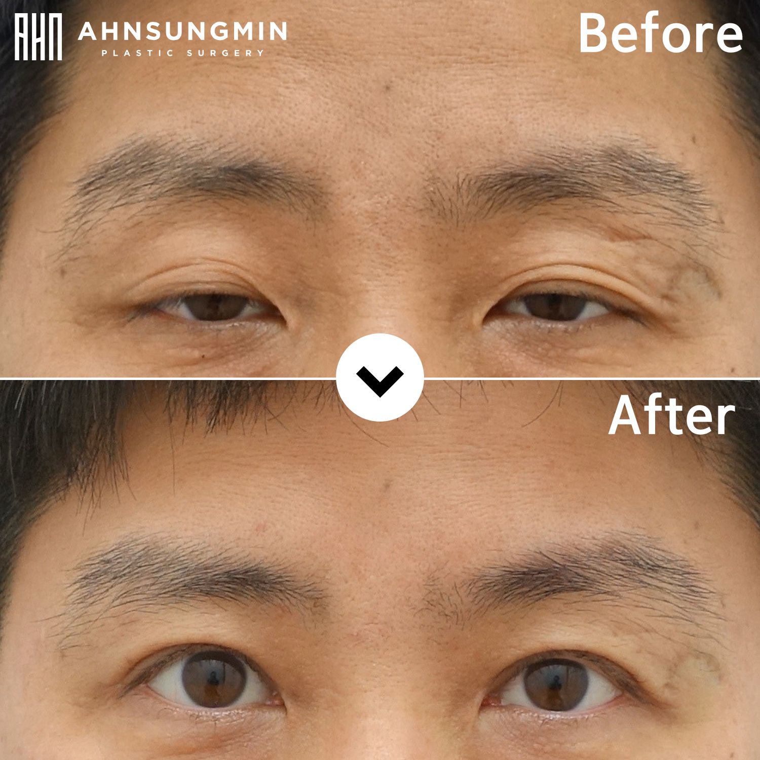 Male ptosis correction in Korea before and 3 months after surgery showing improved eyelid opening
